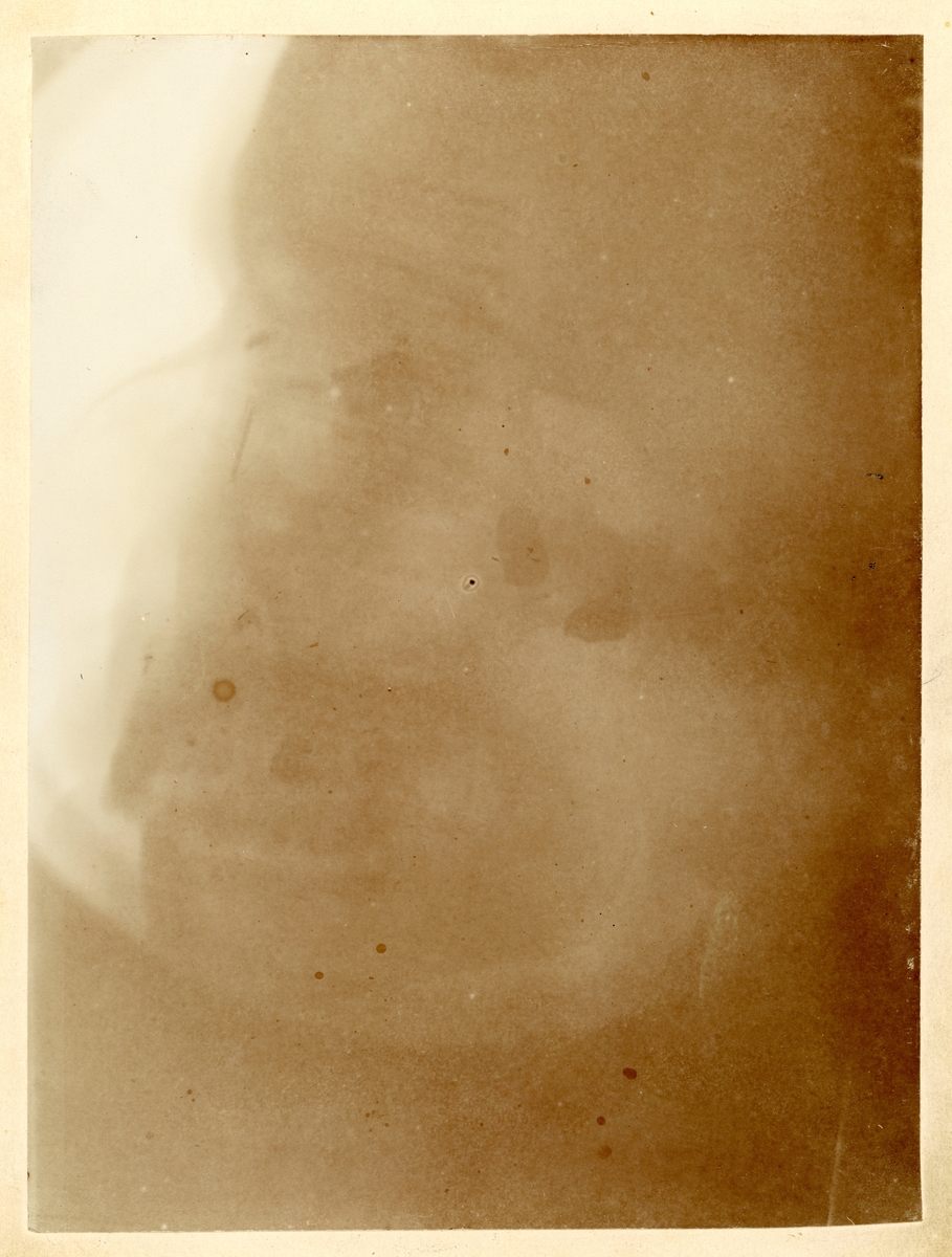Röntenbild av Johan (Johannes) Alméns huvud.

Man kan se de tre kulor som blev kvar i hans huvud efter tågrånet mot postkupén på sträckan Malmö - Simrishamn 1907.