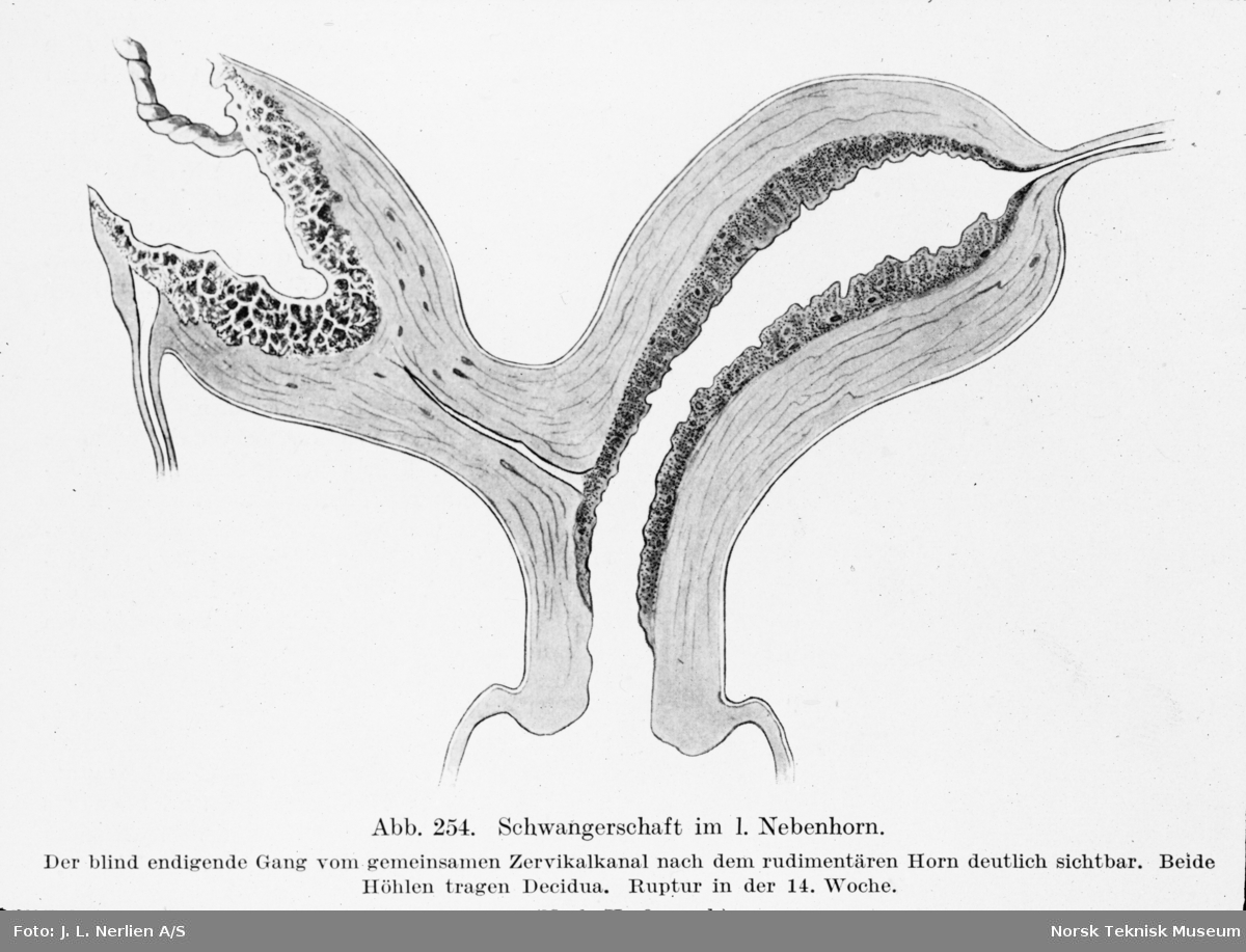 Avfotografert tegning av diagram av graviditet i en "enhjørning livmor", uterus unicornis