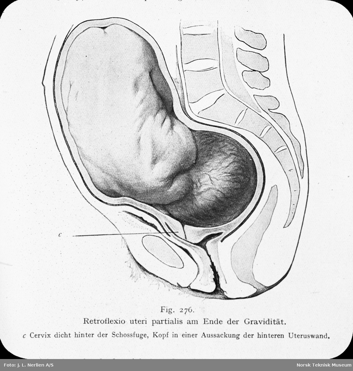 Avfotografert tegning av en delvis bakoverbøyd livmor, retroflexio uteri partialis, ved slutten av en graviditet